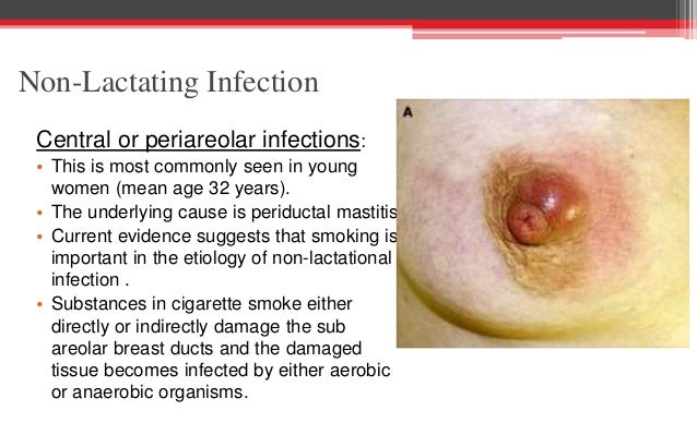 breast mastitis abscess Breast mastitis abscess